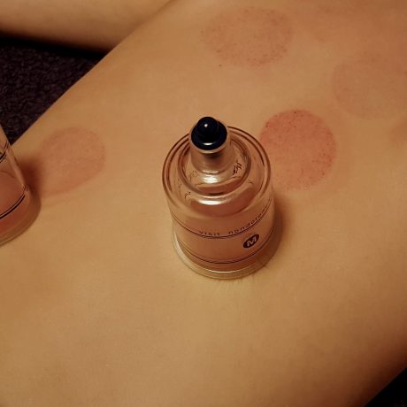 cupping-3310182_1920 cupping-3310182_1920